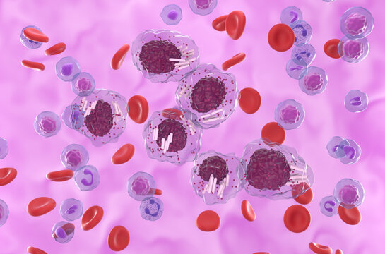 Stem Cell Lymphocytic Leukemia